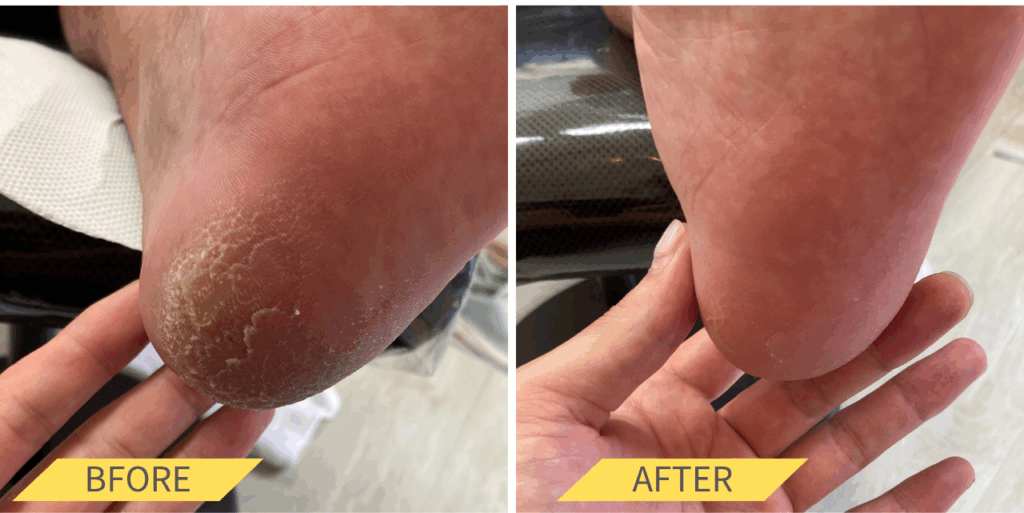 かかと角質ケア
